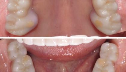 Zirconia implant supported bridges