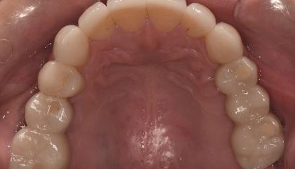 Implant bridges and ceramic veneers