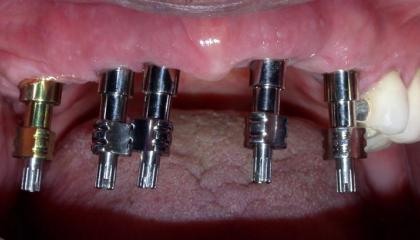 Multiple absent teeth impressions