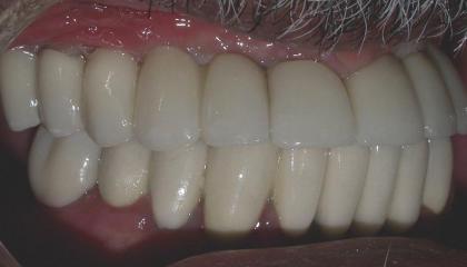 Multiple absent teeth after