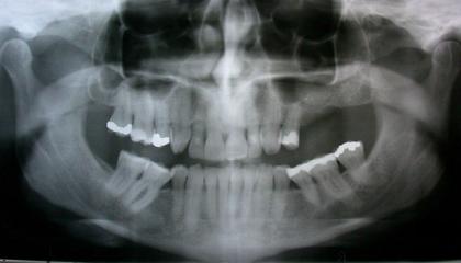Short implants avoiding sinus lift X ray
