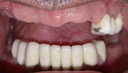 Multiple absent teeth