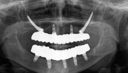 Implants and Zirconia teeth