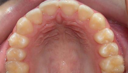 Braces after1